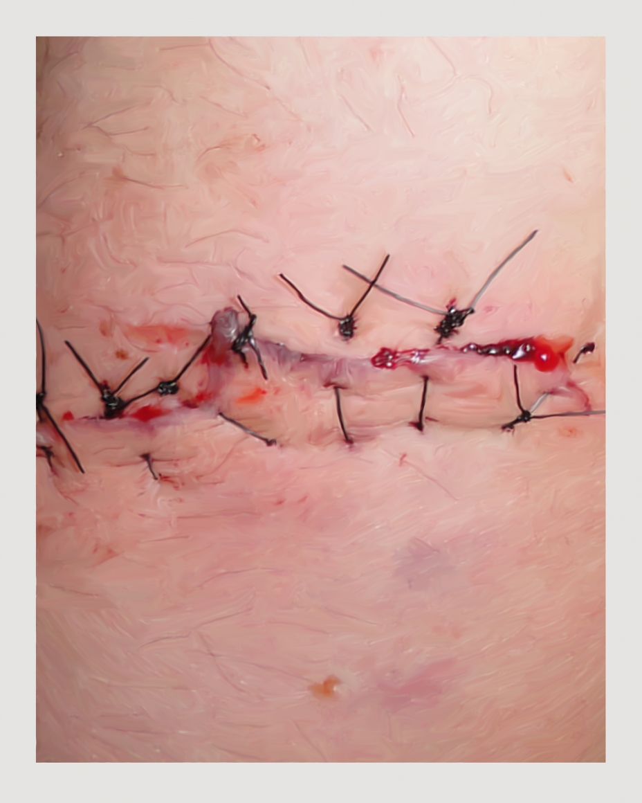 hate crime, DG Krueger, Burke's stitched arm
