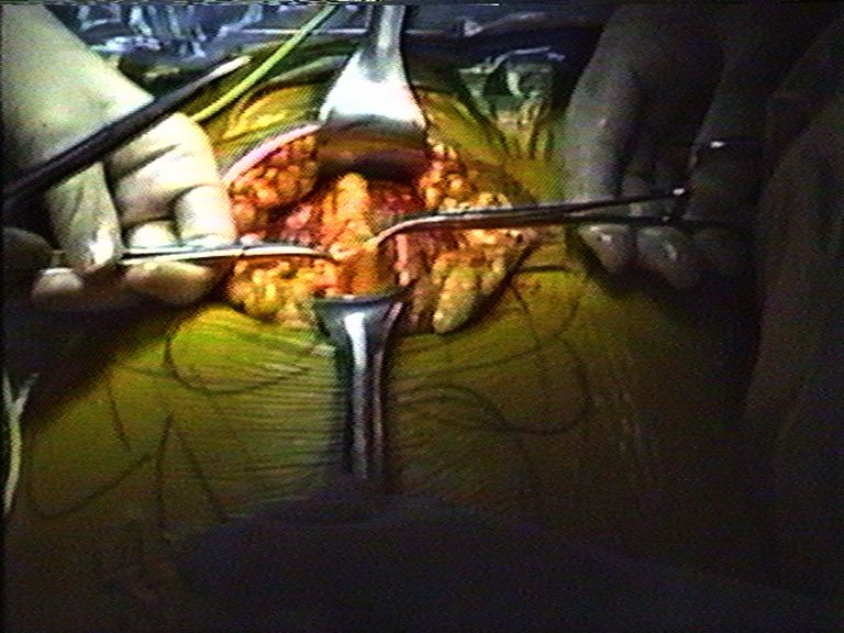 Lutz Bacher, Huge Uterus, 1989
