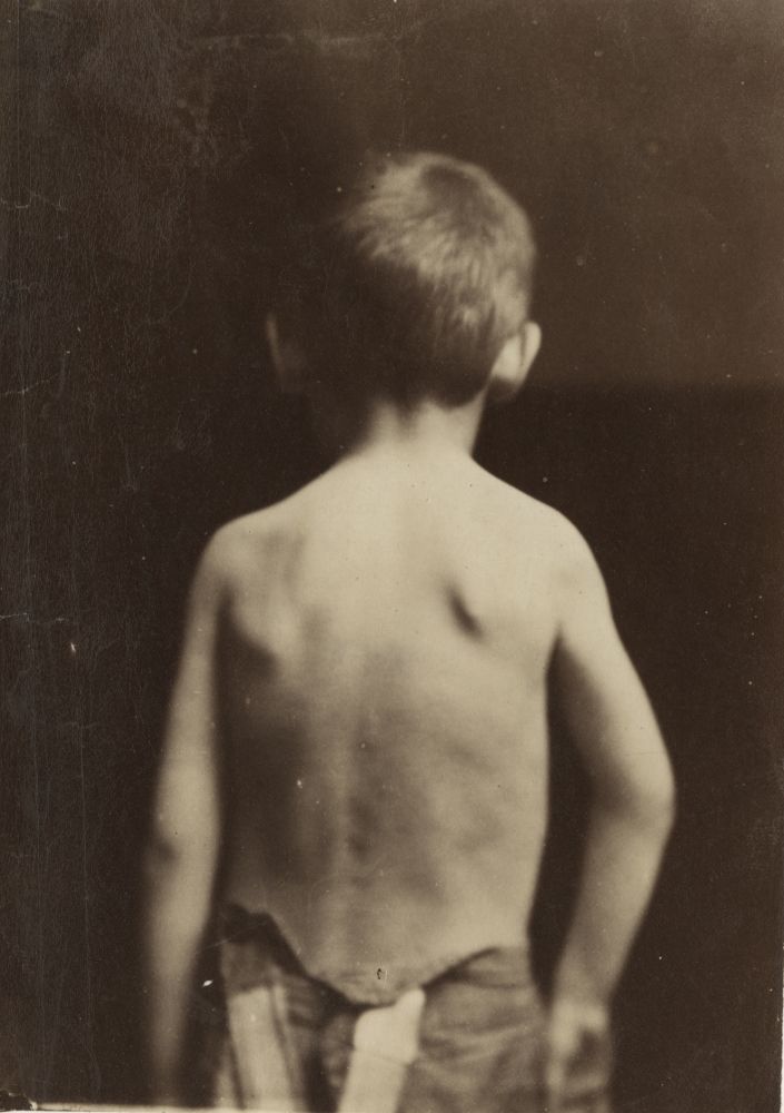 DUCHENNE DE BOULOGNE (French, 1806-1875) Back of a boy, 1865 Albumen print 16.1 x 11.6 cm mounted on 27.3 x 19.2 cm paper "Photographies Pathologiques / Fig. 14. / Phot. par le Dr Duchenne (de Boulogne). / Publié par J. G. Bailliere et Fils, à Paris." printed on mount