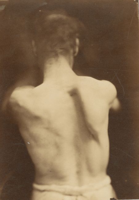 DUCHENNE DE BOULOGNE (French, 1806-1875) Back of a man, 1865 Albumen print 16.1 x 11.6 cm on 27.3 x 19.2 cm plate, mounted "Photographies Pathologiques / Fig. 5. / Phot. par le Dr Duchenne (de Boulogne). / Publié par J. G. Bailliere et Fils, à Paris." printed on mount