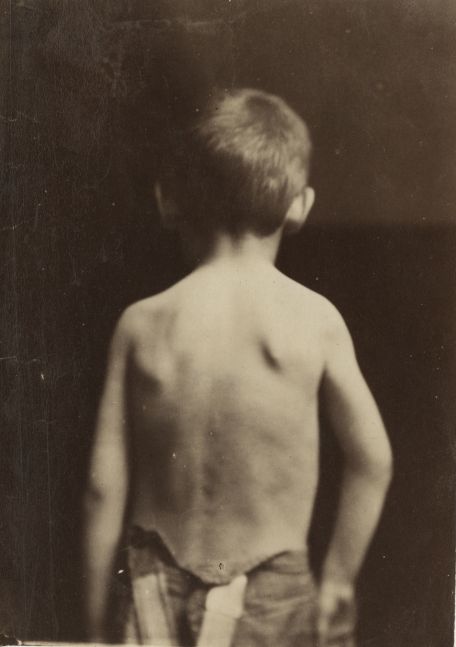 DUCHENNE DE BOULOGNE (French, 1806-1875) Back of a boy, 1865 Albumen print 16.1 x 11.6 cm mounted on 27.3 x 19.2 cm paper "Photographies Pathologiques / Fig. 14. / Phot. par le Dr Duchenne (de Boulogne). / Publié par J. G. Bailliere et Fils, à Paris." printed on mount