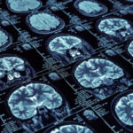 Group logo of Neurological Disorders & Managements