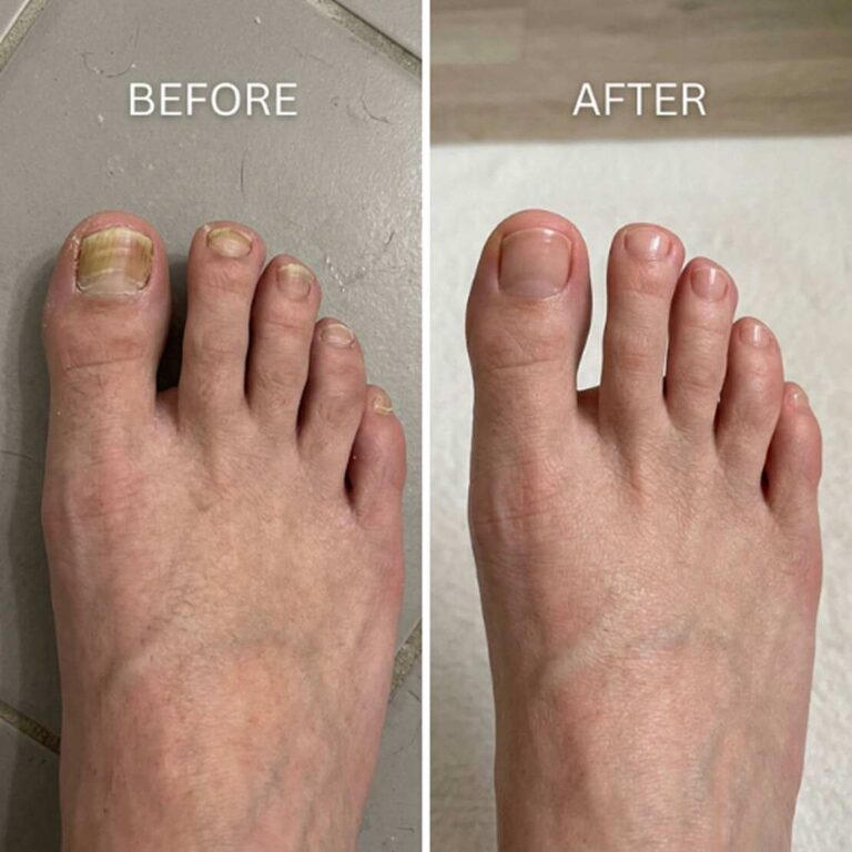 FungaBeam Pen Before and After