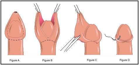 Opinions on Frenulum of prepuce of penis