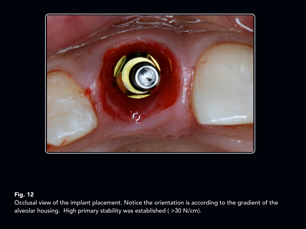 Use of the “Socket Shield Technique” to preserve bone and soft