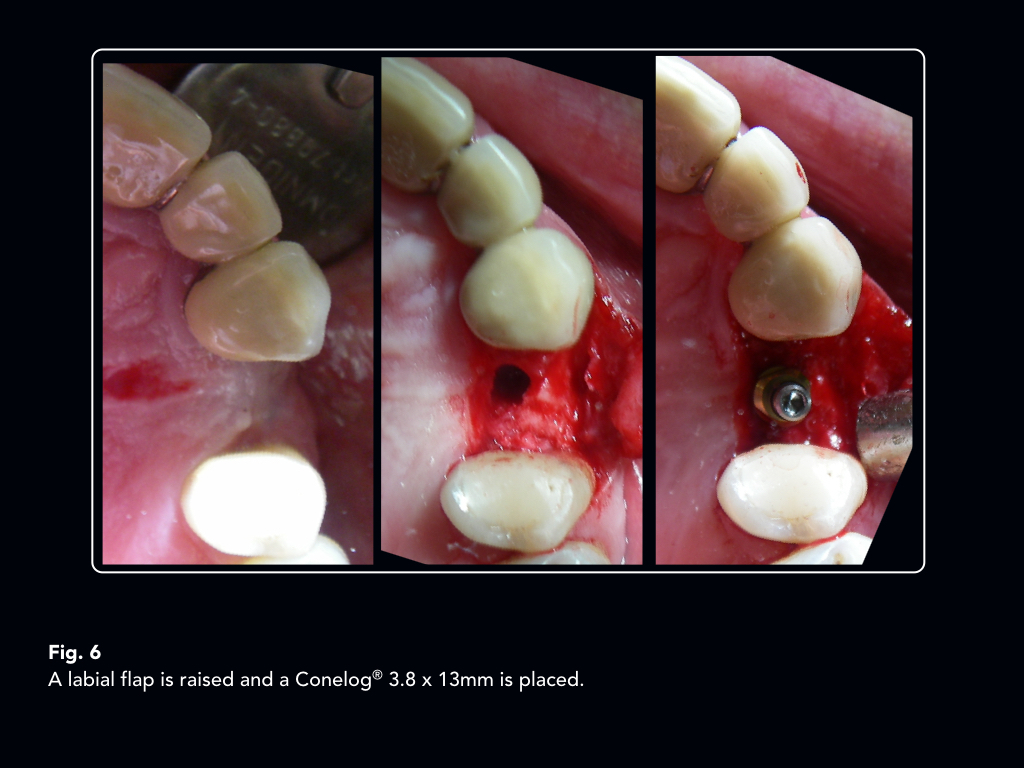 An implant supported telescopic crown convertible to a cantilever