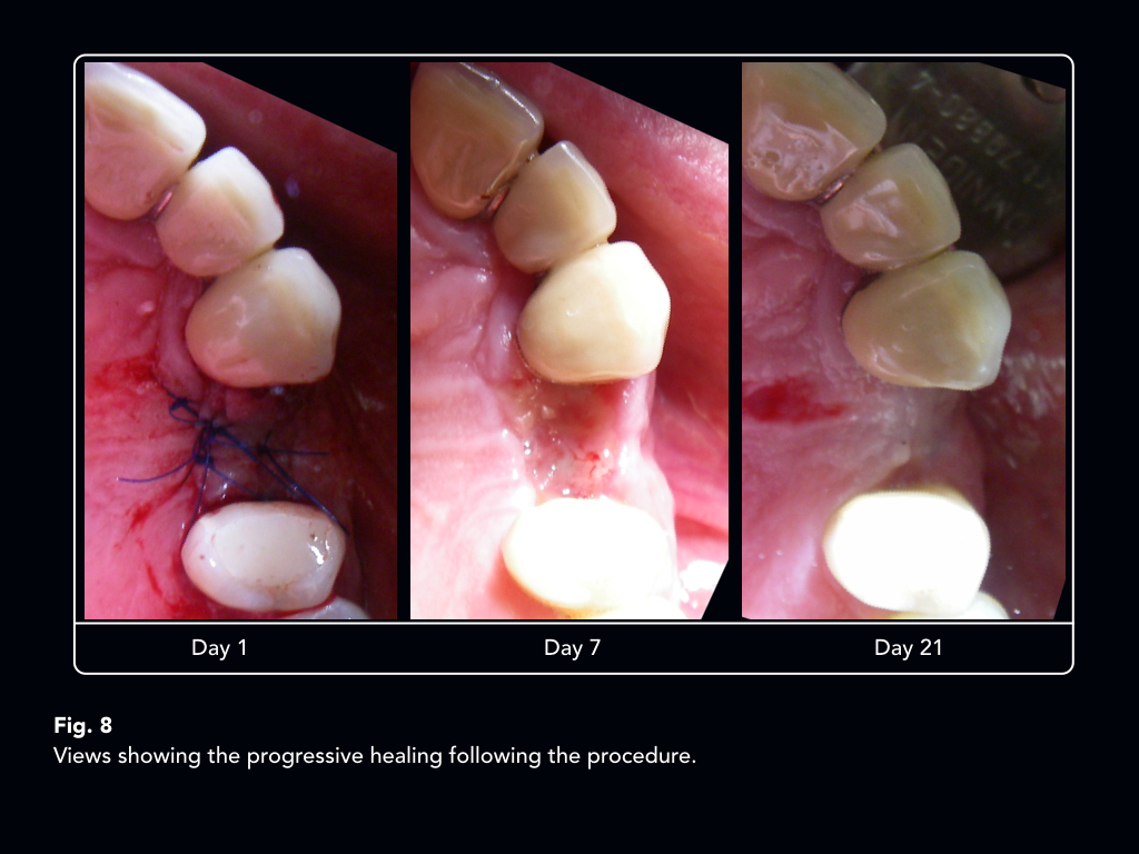 An implant supported telescopic crown convertible to a cantilever