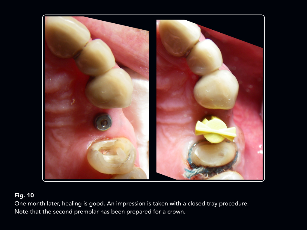 An implant supported telescopic crown convertible to a cantilever