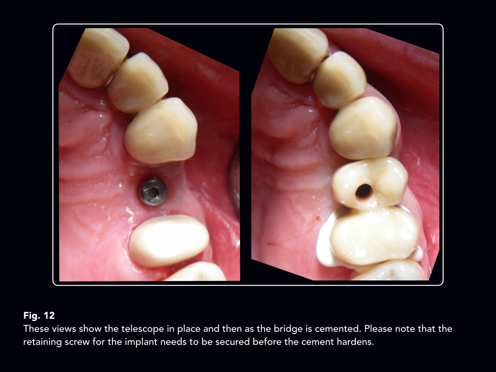 An implant supported telescopic crown convertible to a cantilever