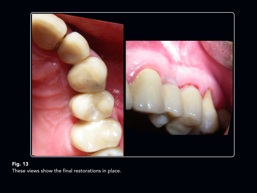 An implant supported telescopic crown convertible to a cantilever