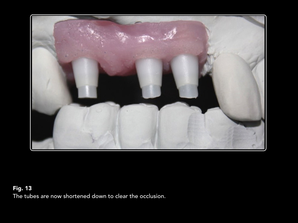 Implantsupported screwretained splint ImplantsConnect