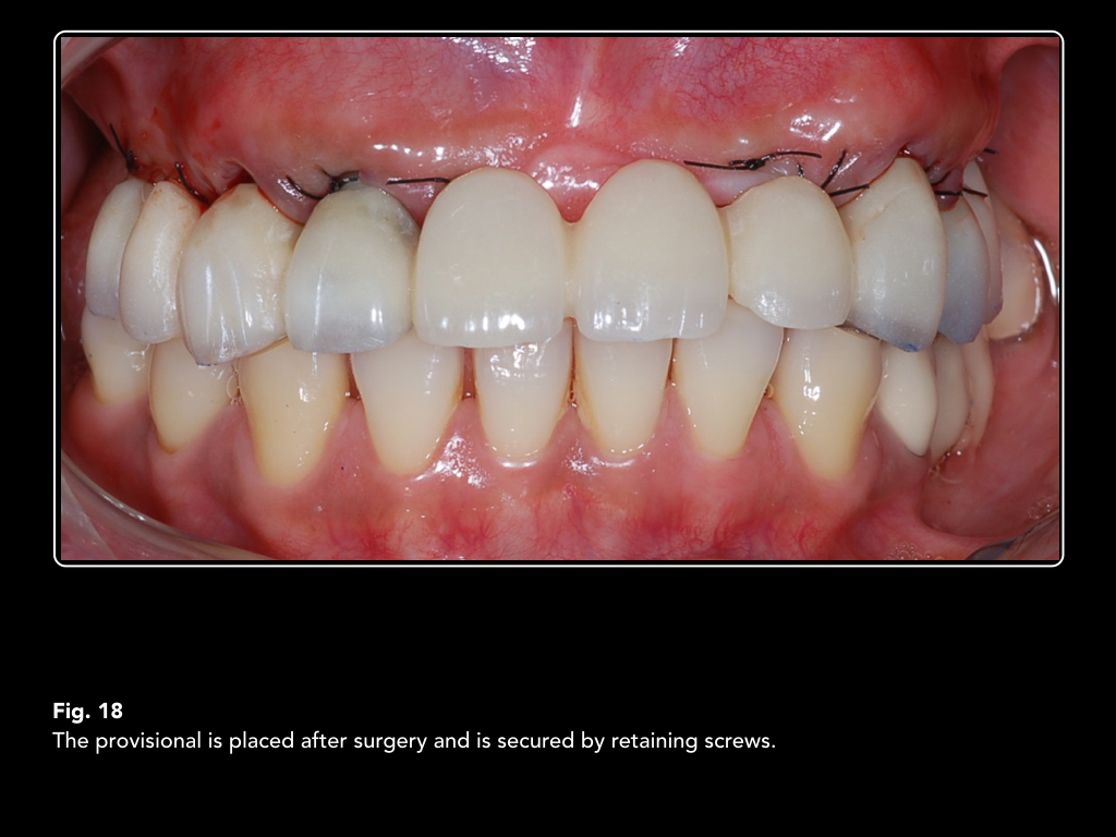Unilateral maxillary swelling image