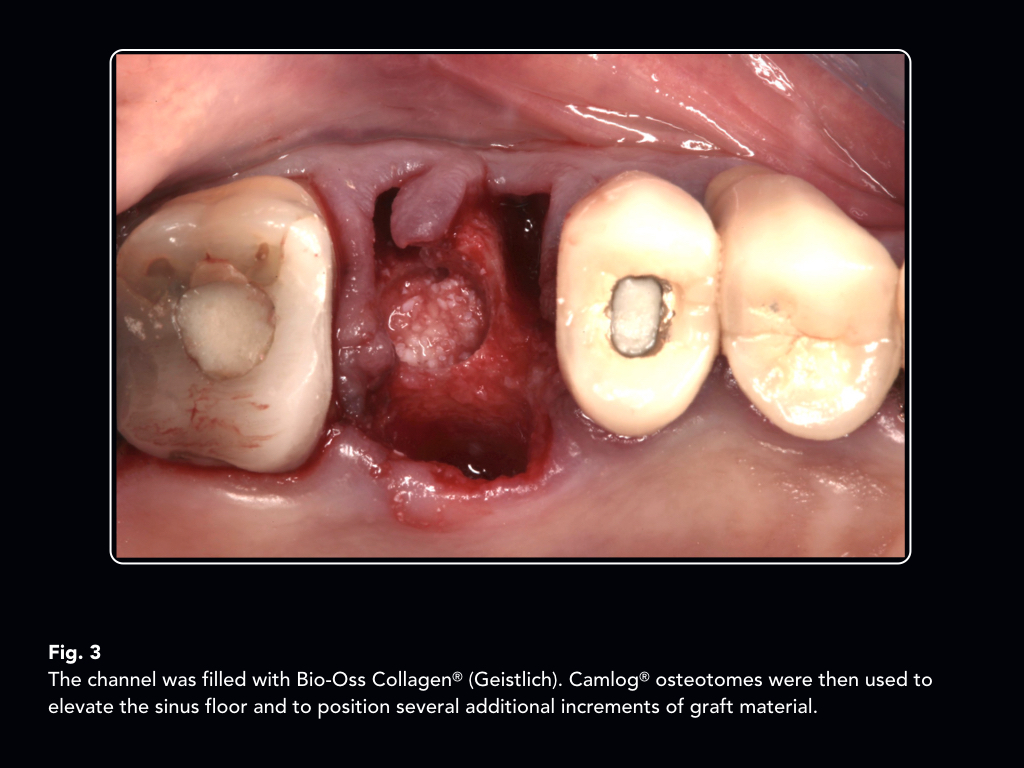 Hydatidiform mole case presentation ppt image