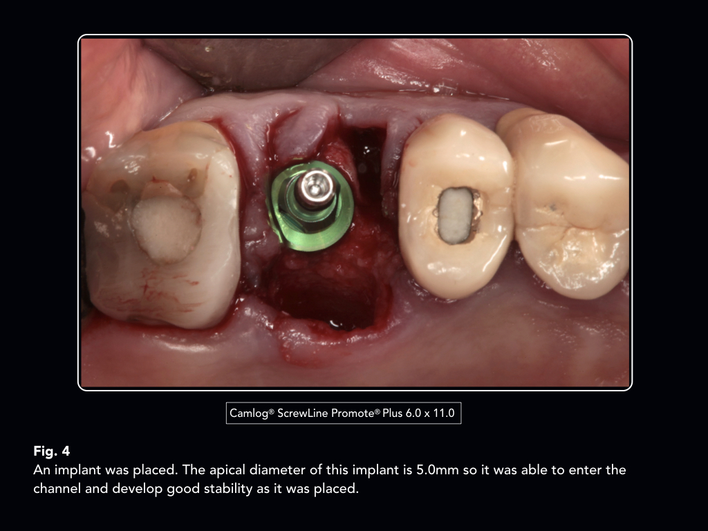 Gestational trophoblastic disease case presentation image