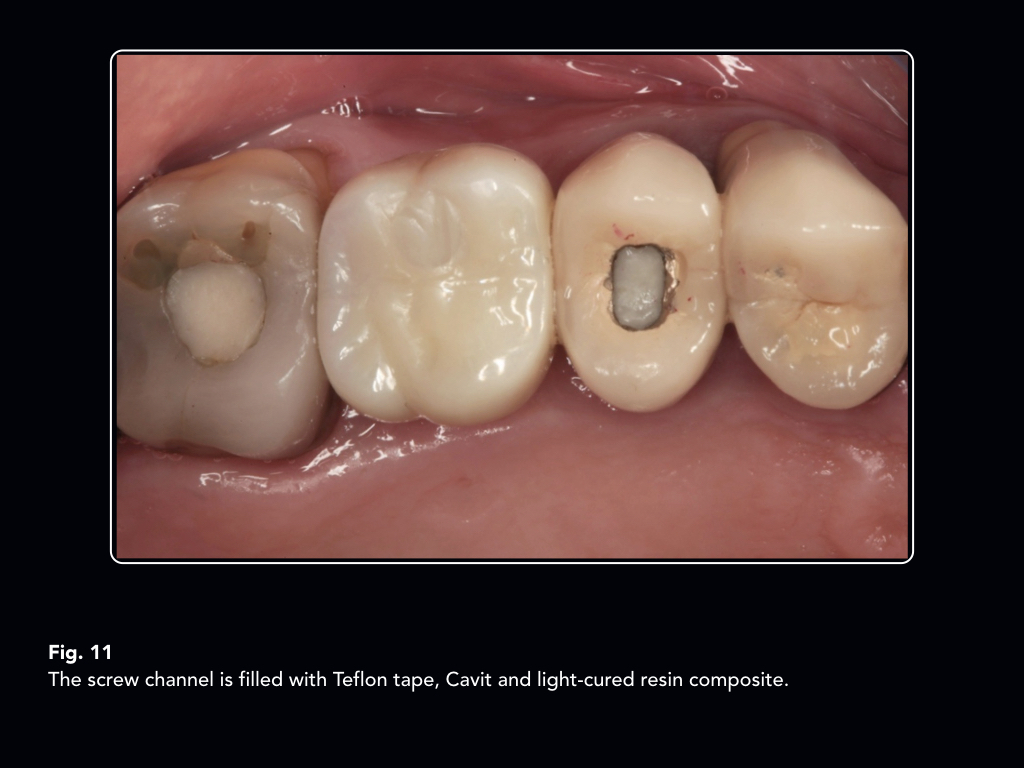 Molar pregnancy case study picture