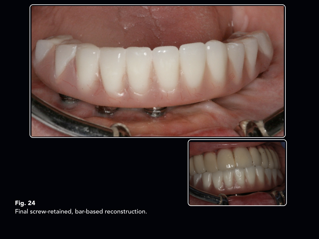 Bisphosphonate related osteonecrosis of the mandible following dental