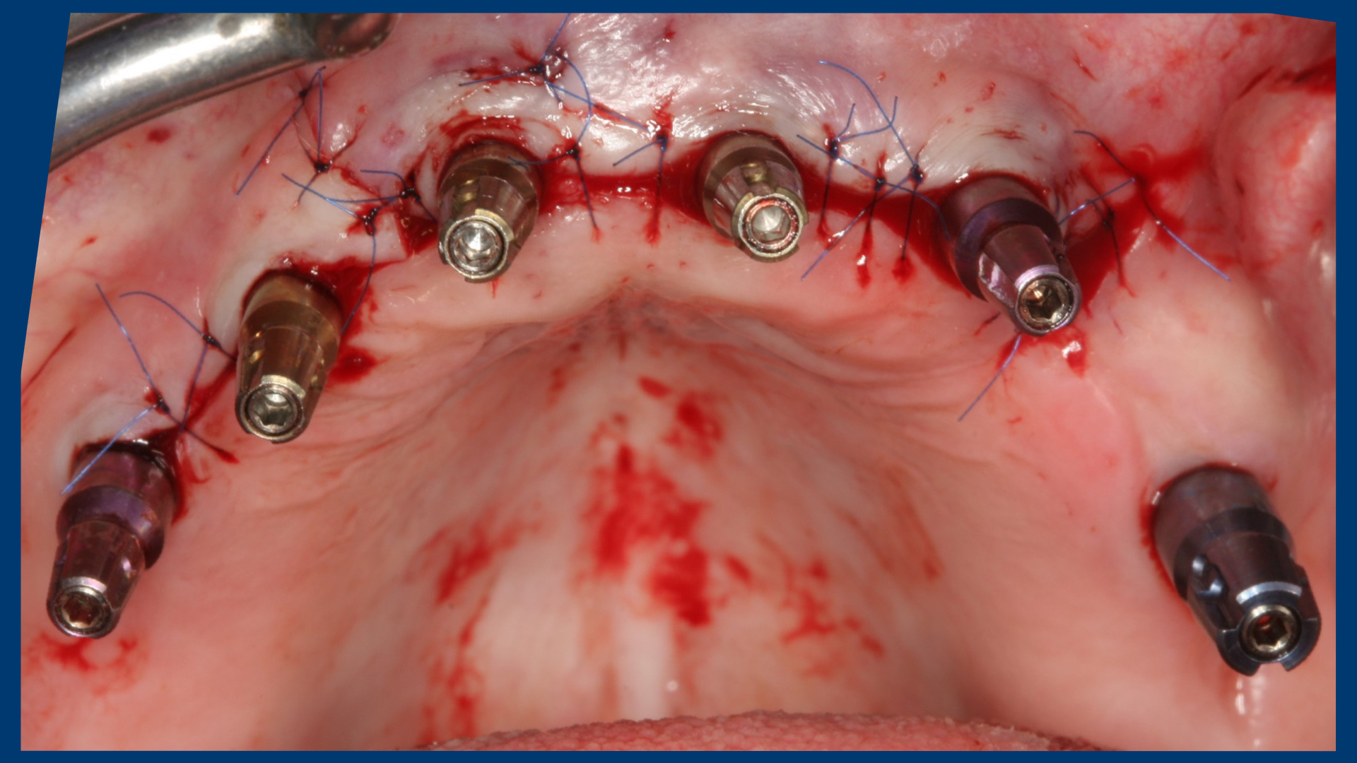 Maxillary mass differential diagnosis picture