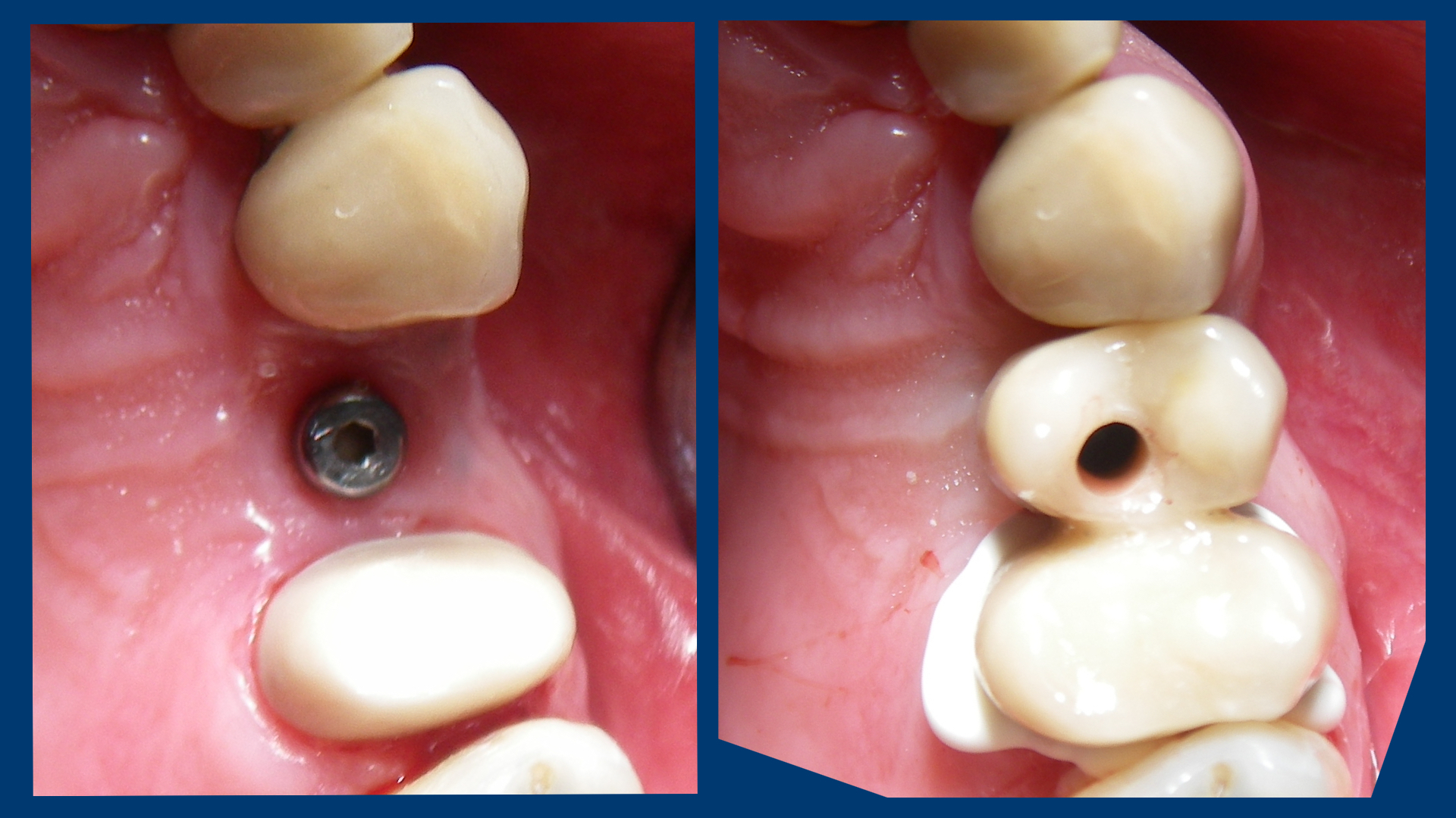 An implant supported telescopic crown convertible to a cantilever