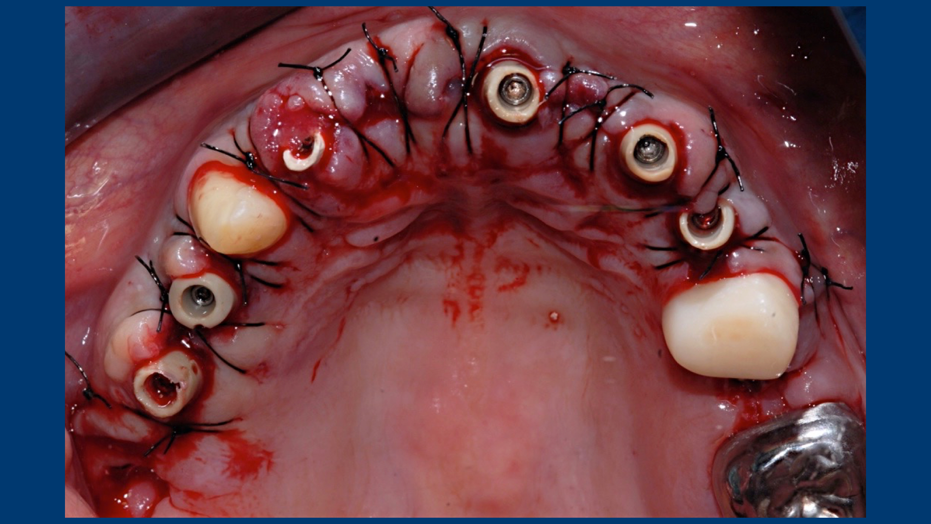 Fibrous dysplasia of maxilla ppt picture