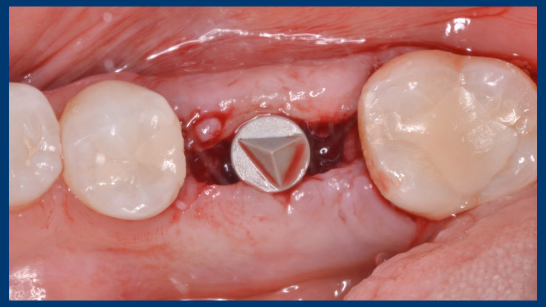 Hydatidiform mole: case study image