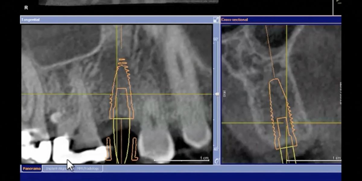 Design process for a primary canine replacement ImplantsConnect