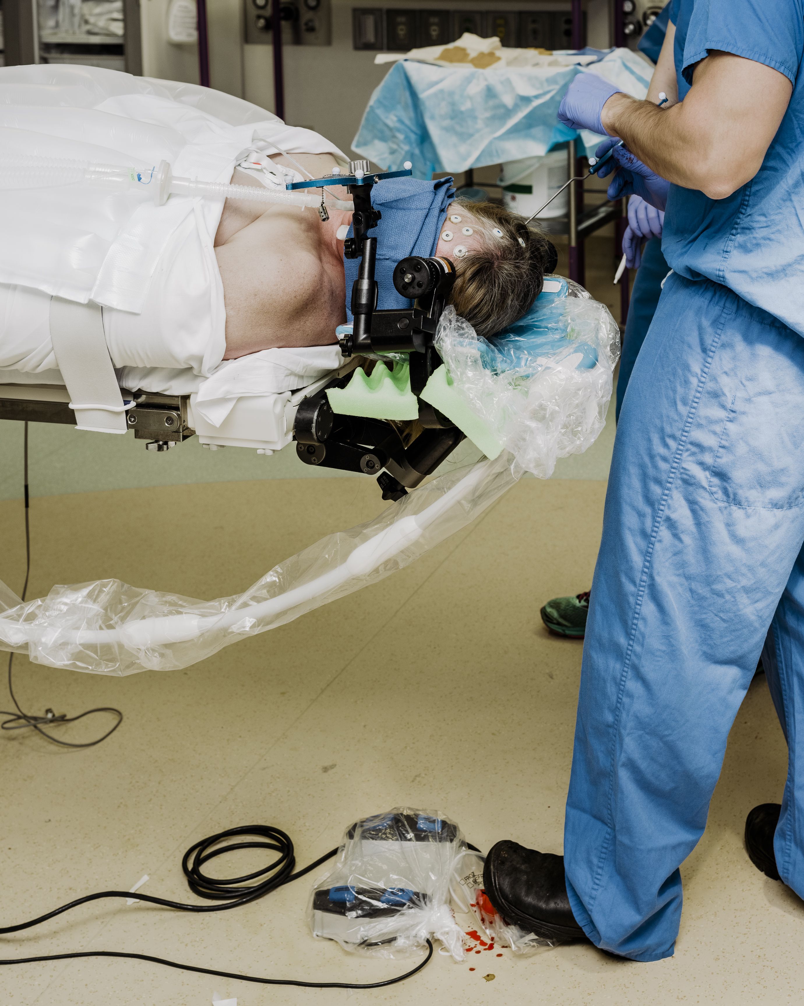 Uno de los pacientes de Leuthardt está posicionado para la cirugía láser mínimamente invasiva para tratar un tumor cerebral. Tales técnicas quirúrgicas altamente precisas han hecho que los electrodos de implante sean más seguros y menos desalentadores para los pacientes.