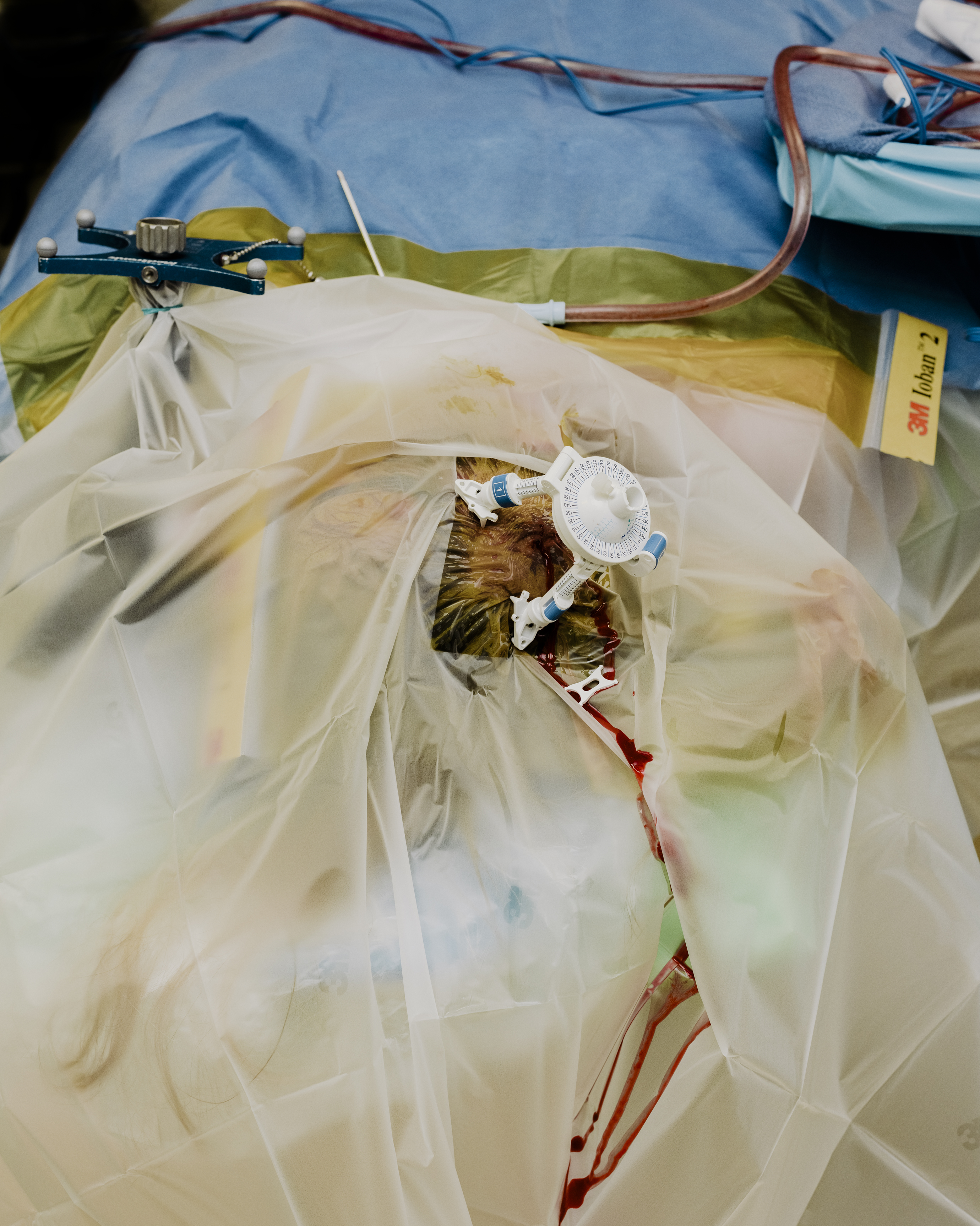 Un marco estereotáctico fijado al cráneo de un paciente guía una sonda láser que señala una ubicación en el cerebro.