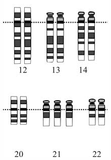 down syndrome treatment