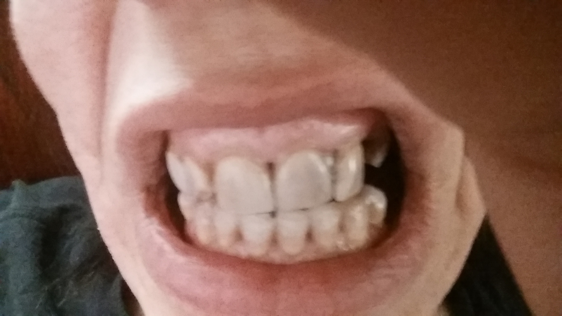 Where Can I Donate Dentures