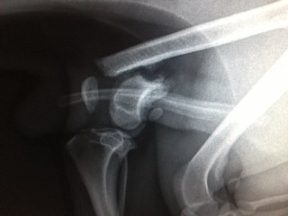 Distal Femoral Fracture w Knee Displacement Distal Femoral Fracture w Knee Displacement