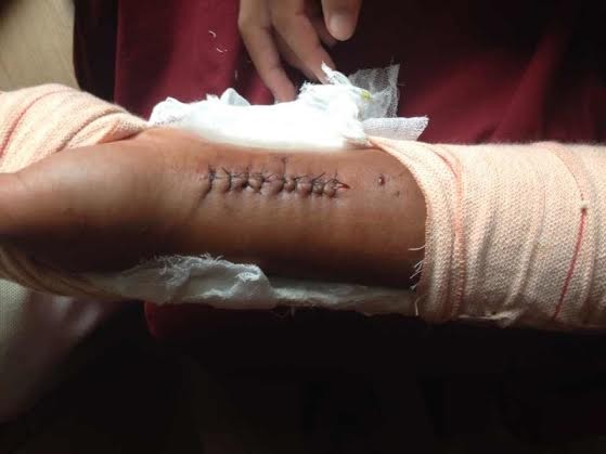 arm with stiches arm with stiches