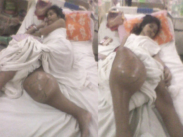 Annie July 2014, the tumor has grown twice as big as compared to last April. Annie July 2014, the tumor has grown twice as big as compared to last April.