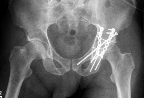 Pat Pelvis post-OP Pat Pelvis post-OP