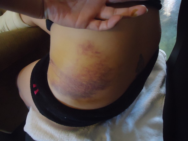 Seat belt bruising Seat belt bruising