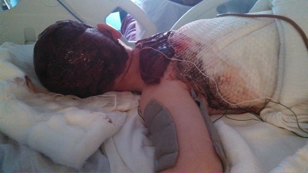 After his first skin graft surgery - The dark red you see is where they took skin to put on his back. After his first skin graft surgery - The dark red you see is where they took skin to put on his back.