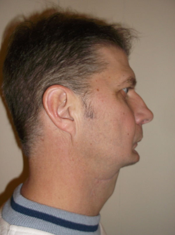 After a couple of surgeries After a couple of surgeries