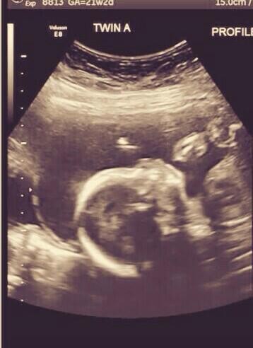 Baby A Baby A