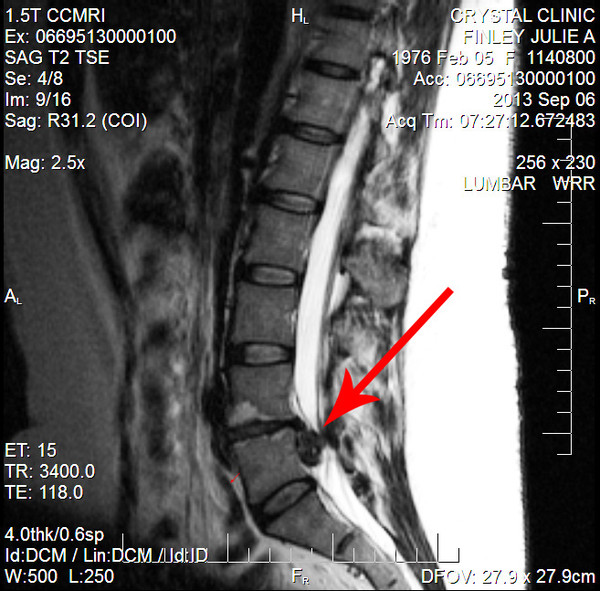 Massive Herniation Massive Herniation