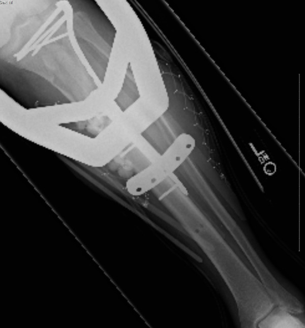 Left Knee post-OP Left Knee post-OP