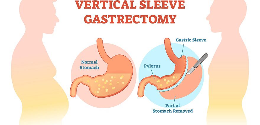 Bariatric Sleeve