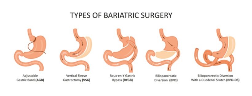 Bariatric Liquid Vitamins And Minerals