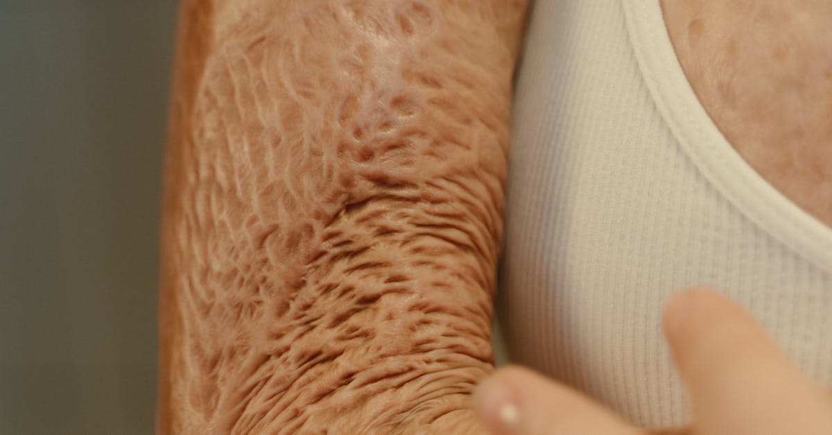 Revolutionary \"Skin in a Syringe\" Promises Scar-Free Burn Healing