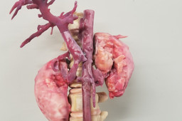 Kidney tumor pre-surgical planning model