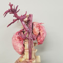 Kidney tumor pre-surgical planning model