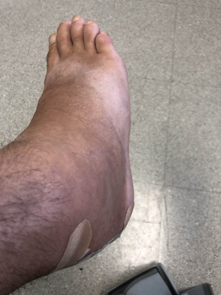 Journey on returning from Achilles surgery to my right foot....gnarly