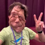 La neurofibromatosis: la enfermedad de Adam Pearson explicada