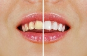 Harmonização Orofacial Harmonização Orofacial