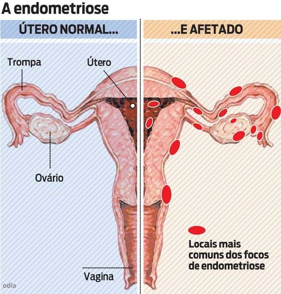 Endometriose X contraceptivos hormonais