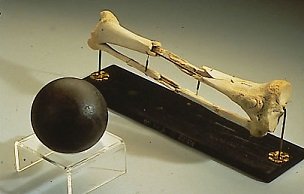 The shattered femur of Daniel Sickles- headstuff.org