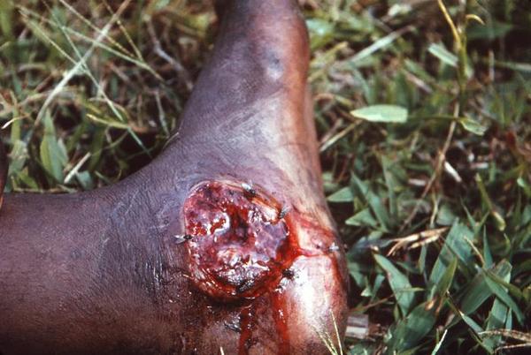 Skin Ulcerations